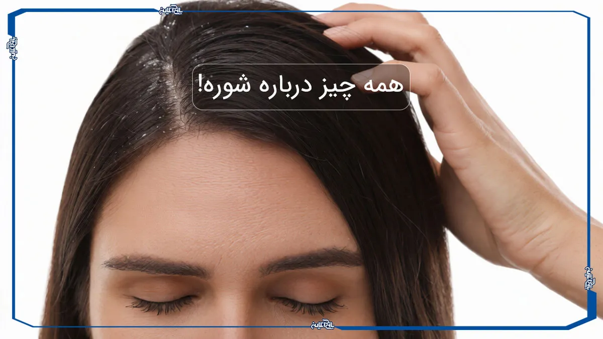 شوره سر چیست بررسی علت، انواع و تفاوت آن با پوسته سر با معرفی روش های خانگی برای درمان
