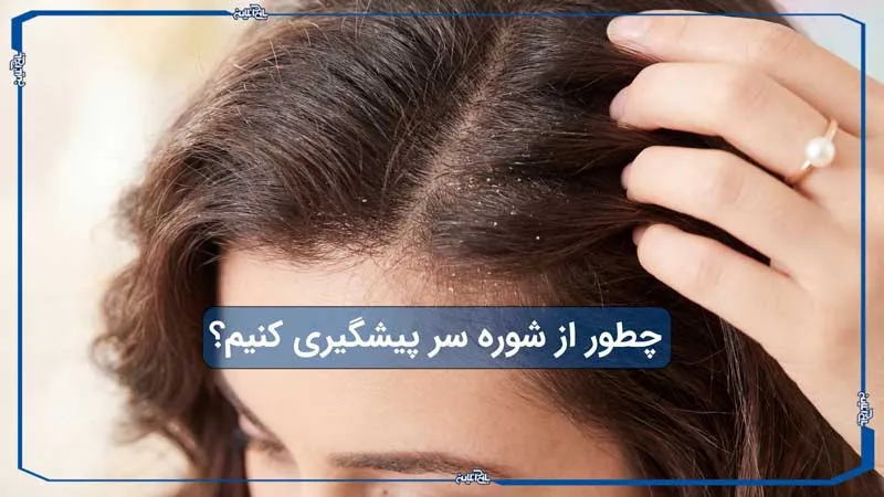 چطور از شوره سر پیشگیری کنیم