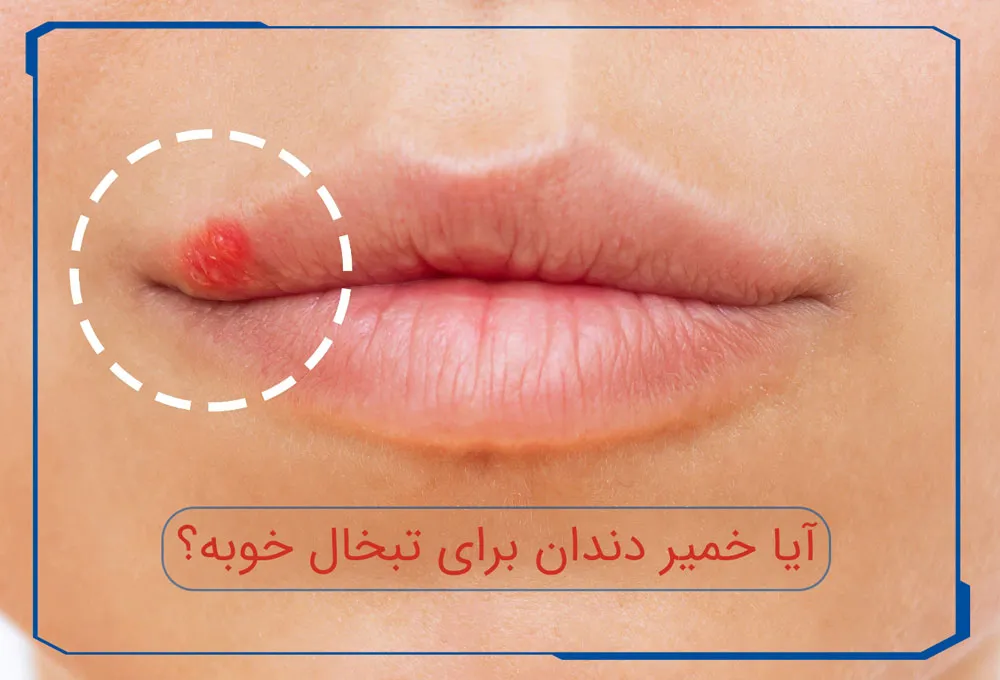 آیا خمیر دندان برای تبخال خوبه