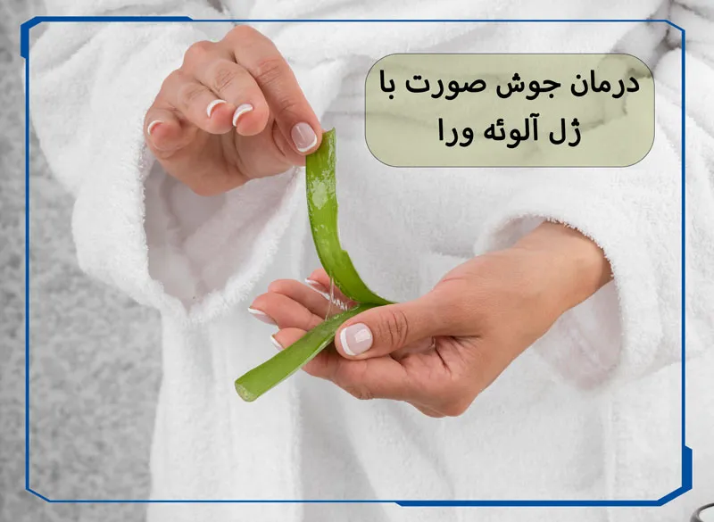 درمان جوش صورت با ژل آلوئه ورا