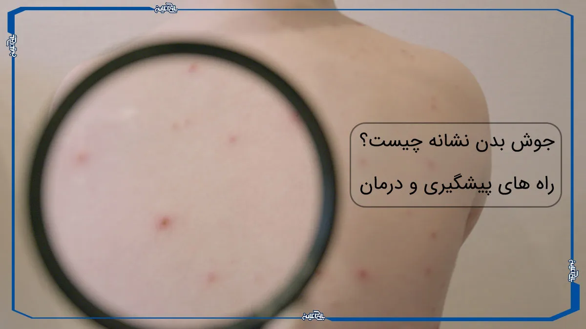 جوش بدن نشانه چیست؟+راه های پیشگیری و درمان