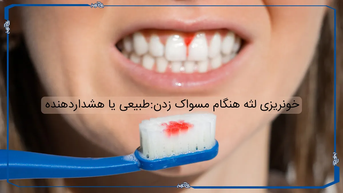 خونریزی لثه هنگام مسواک زدن: طبیعی یا هشدار دهنده