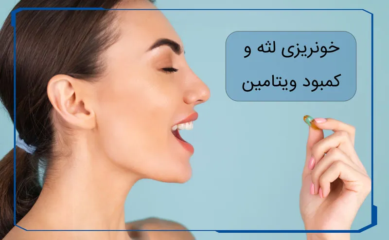 خونریزی لثه هنگام مسواک زدن نشانه کمبود کدام ویتامین است