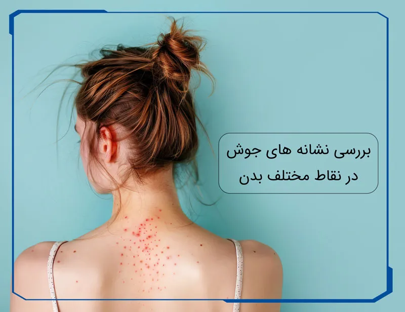 جوش بدن نشانه چیست