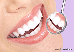 سفید کننده دندان را می توان به چهار دسته تقسیم کرد.