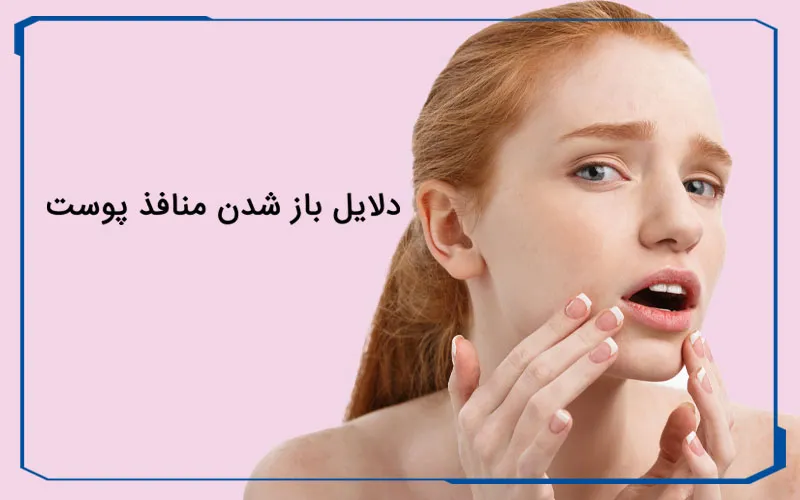 دلایل باز شدن منافذ پوست