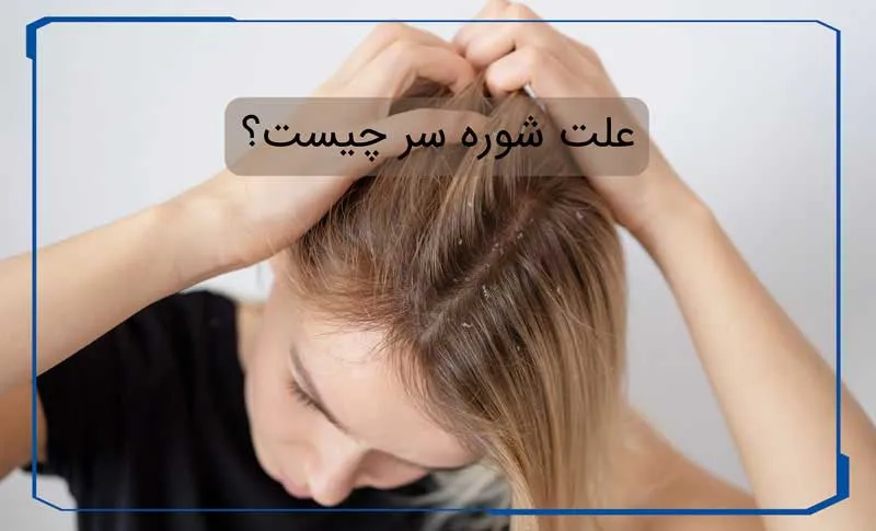 علت شوره سر چیست