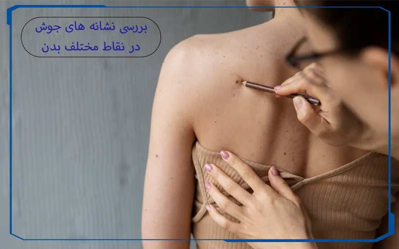نشانه های جوش در بدن